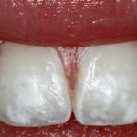 белые пятна на зубах