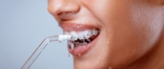 Как выбрать ирригатор для ухода за брекетами