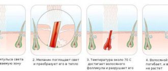 The principle of operation of the photoepilator